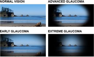 Glaucoma vision images