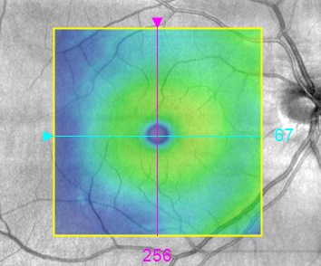 Check Out the Latest in Optometry Technology - Eyecare Associates of ...