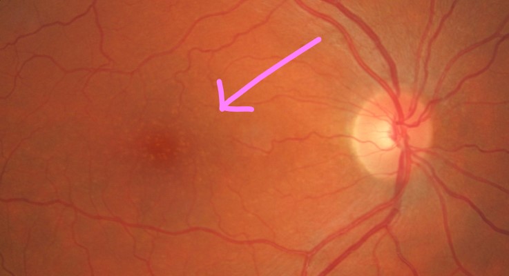 Image of mild macular degeneration with scattered drusen throughout the macula.