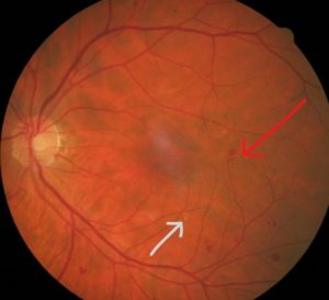 diabetic retinopathy heme exudate